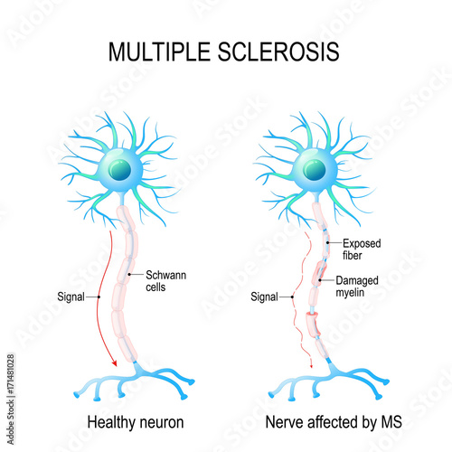 Multiple sclerosis. autoimmune disease.