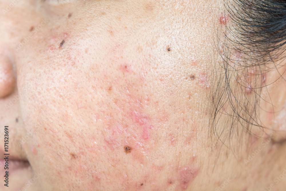 Fototapeta premium scar from acne on face