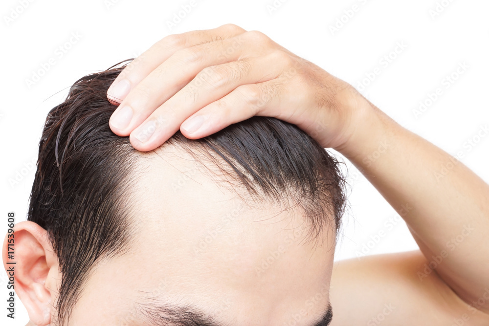 Young man serious hair loss problem for health care shampoo and beauty product concept Young man serious hair loss problem for health care shampoo and beauty product concept