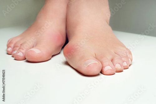 Hallux valgus, bunion in foot on white background photo