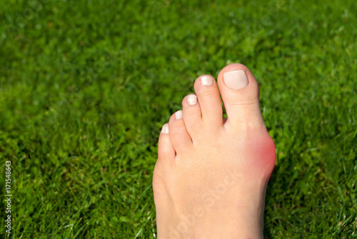 Hallux valgus, bunion in foot on grass background