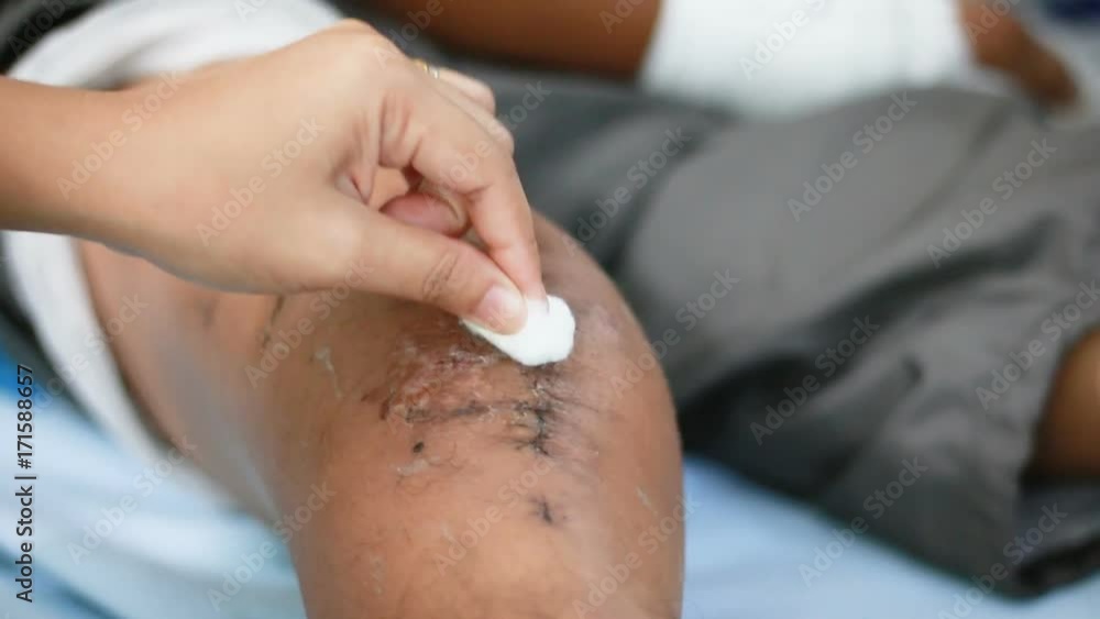 Hand of woman using cotton to cleaning surgery wound broken bone knee of the man Hand of woman using cotton to cleaning surgery wound broken bone knee of the man
