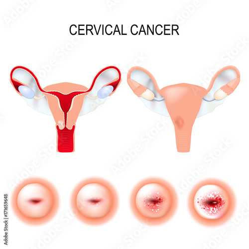 Cervical cancer staging