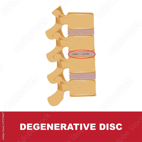 human disc degeneration. degenerative disc vector illustration