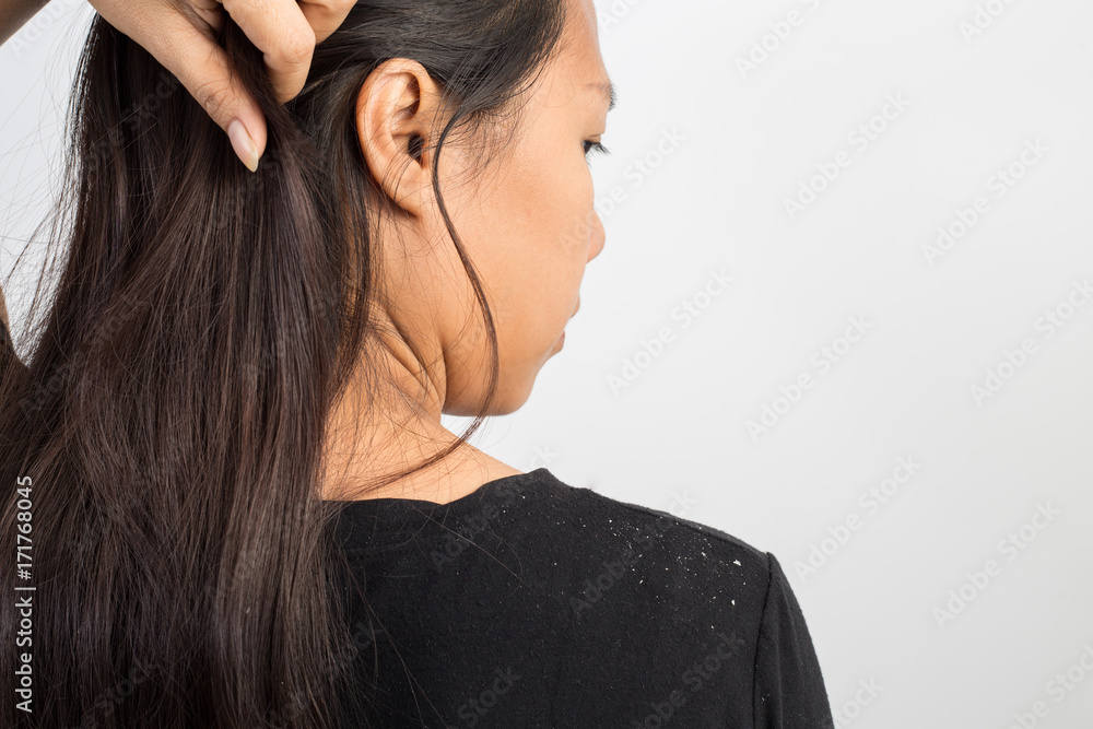 women having dandruff in the hair and shoulder women having dandruff in the hair and shoulder