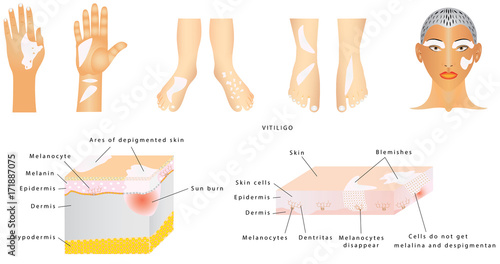 Vitiligo