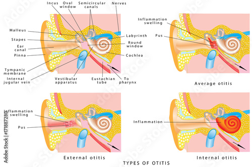 Ear otitis
