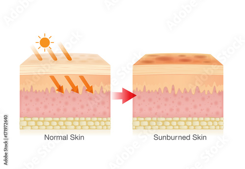 Effect of sunlight cause sunburned skin. Illustration about danger of UV rays.