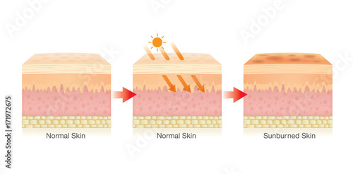 Step of Changing of human skin layer damaged from sunlight. Illustration about Health care.