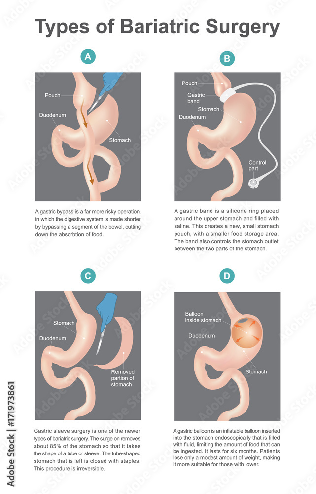 Obraz premium Types of bariatric surgery, it’s process for the digestive system in stomach, .A new types of bariatric surgery result in patients lose only of weight. Part of human body. Infographic vector..