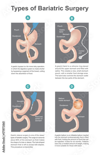 Types of bariatric surgery, it’s process for the digestive system in stomach, .A new types of bariatric surgery result in patients lose only of weight. Part of human body. Infographic vector..