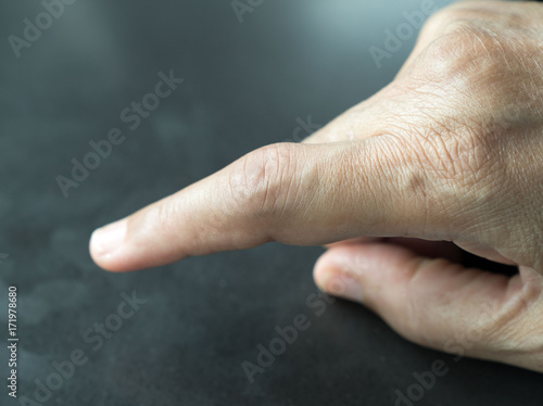 Hand of patient Rheumatoid Arthritis