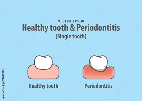 Healthy tooth & Periodontitis (Single tooth) illustration vector on blue background. Dental concept.