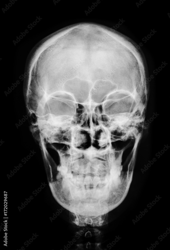 front face skull x-ray. front face skull x-ray.