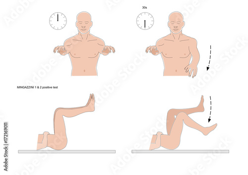 A neurological examination: the Mingazzini 1 and 2 test (positive)