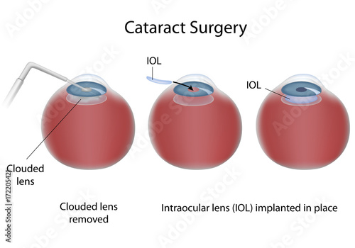 Cataract surgery  photo