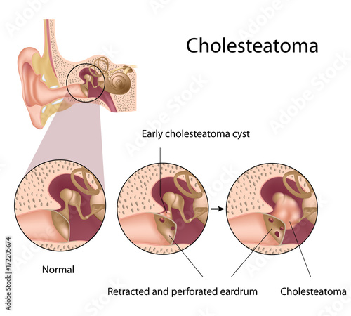 Cholesteatoma  photo