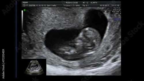 Ultrasound at 12 weeks gestation