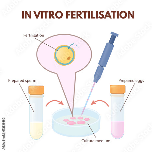In vitro fertilization