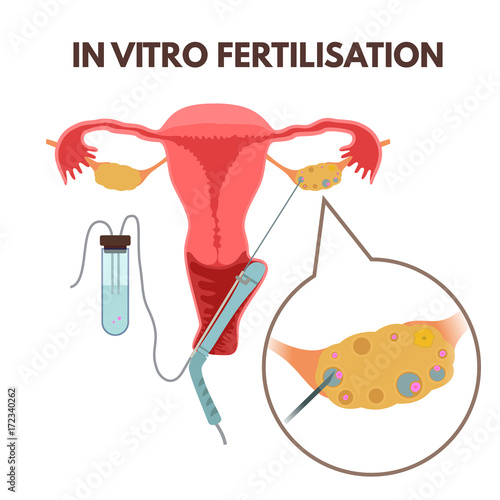 In vitro fertilisation