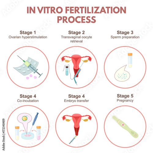 In vitro fertilization