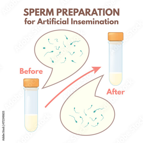 preparation of sperm