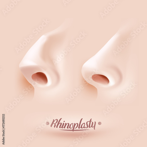 Rhinoplasty surgery example. Nose before and after rhinoplasty. Vector illustration