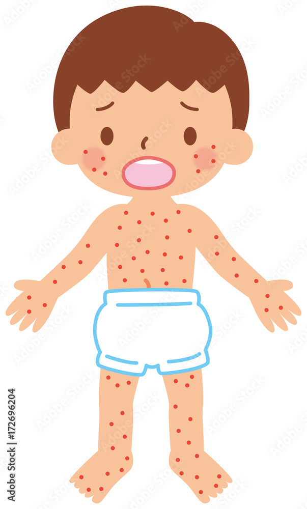 Obraz premium 突発性発疹の子供