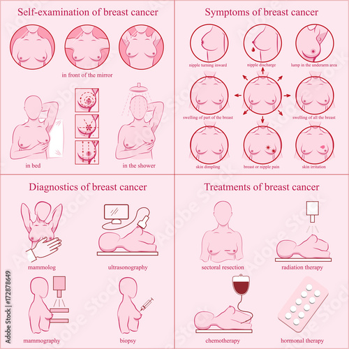 Breast cancer set. Self-examination, symptoms, diagnostics, treatments. Medicine, pathology, anatomy, physiology, health. Info-graphic. Vector illustration. Healthcare poster or banner template.
 photo