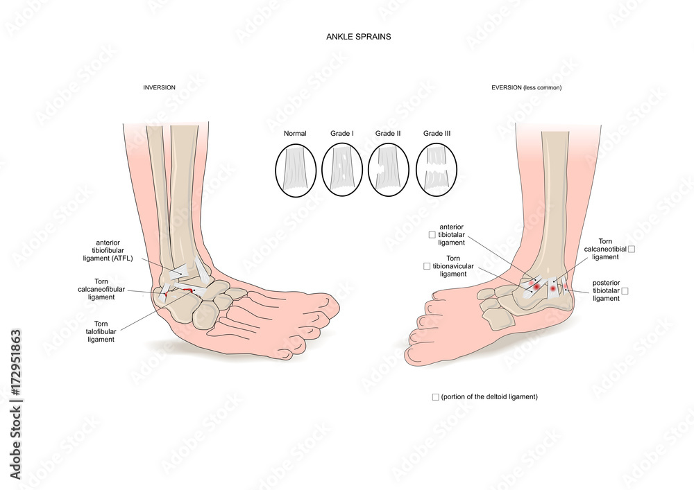 Two common types of ankle sprain (inversion and eversion) Stock Vector