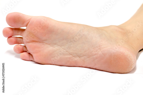 Women's heel feet dry On a white background