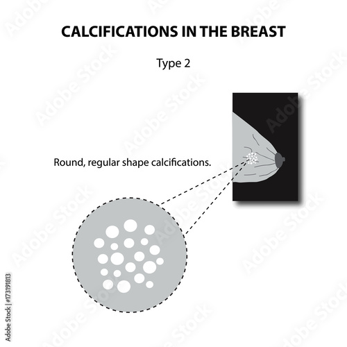 Calcifications in the breast. Mammography. The mammary gland. Infographics. Vector illustration on isolated background