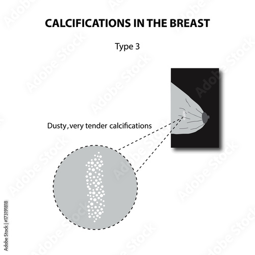 Calcifications in the breast. Mammography. The mammary gland. Infographics. Vector illustration on isolated background photo