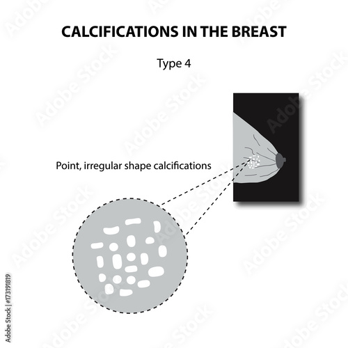 Calcifications in the breast. Mammography. The mammary gland. Infographics. Vector illustration on isolated background photo