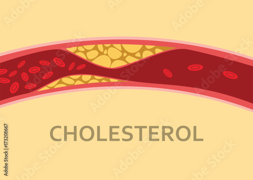 a cholesterol human body vein with blood cell stream