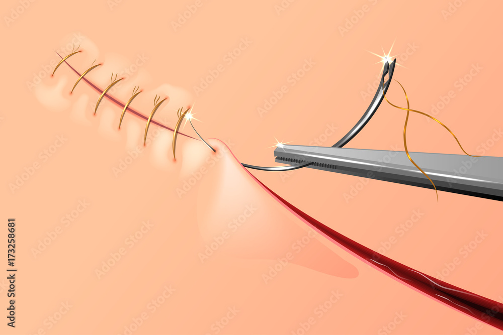 stitching of the wound Stock Vector Adobe Stock