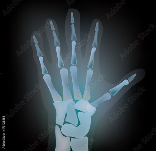 Hand under xray