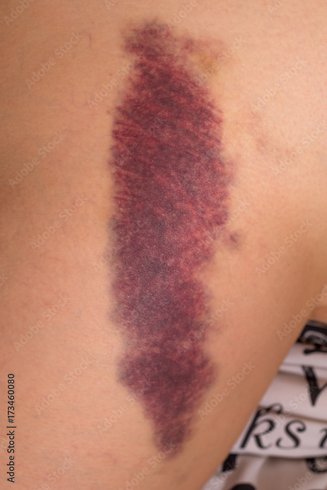 Fototapeta premium Hematoma on the thigh. Bumpy leg.