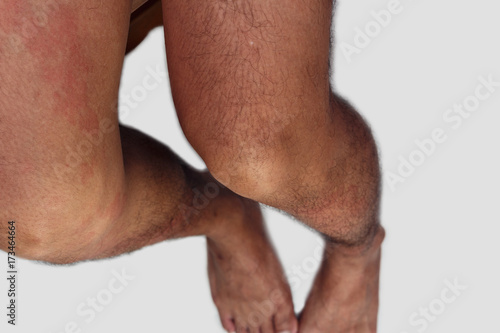 Leg area of man with dermatitis problem of rash ,allergy rash and Health problem