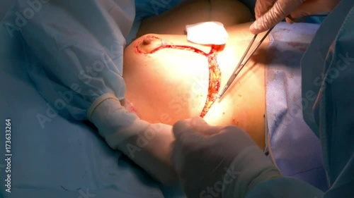 Breast lift surgery