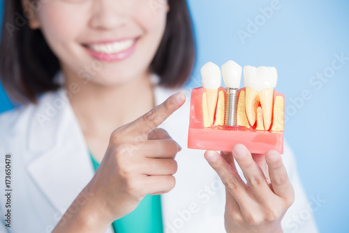 woman dentist take implant tooth