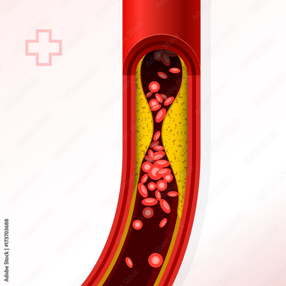 Fototapeta premium Artery section with cholesterol buildup - cholesterol and thrombosis