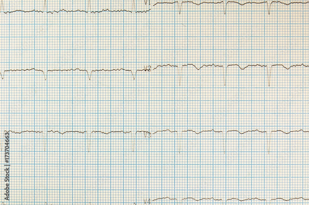 Heart analysis, electrocardiogram graph (ECG) Heart analysis, electrocardiogram graph (ECG)