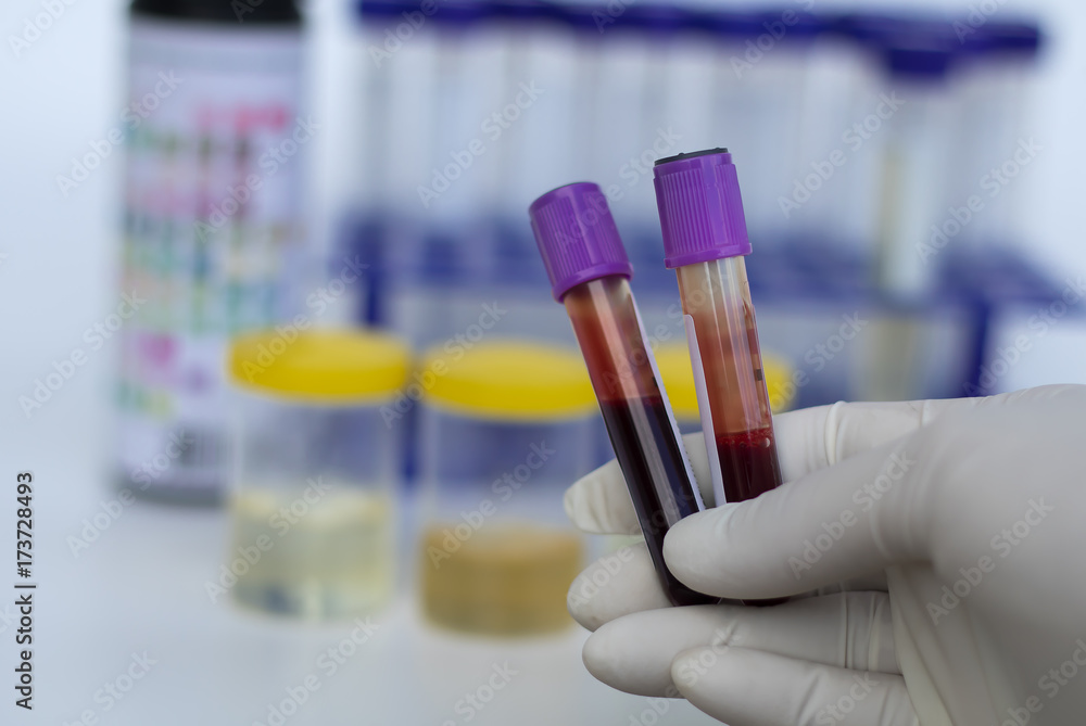 blood test with urine sample test,Doctor holding a container in hand, isolated on white background, Urine sample test. blood test with urine sample test,Doctor holding a container in hand, isolated on white background, Urine sample test.
