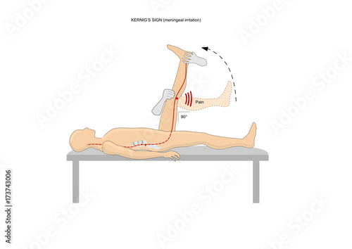Kernig's sign, a neurological test to evaluate a meningeal irritation
