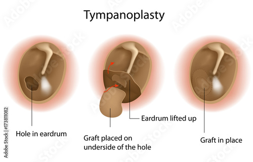 Tympanoplasty labeled