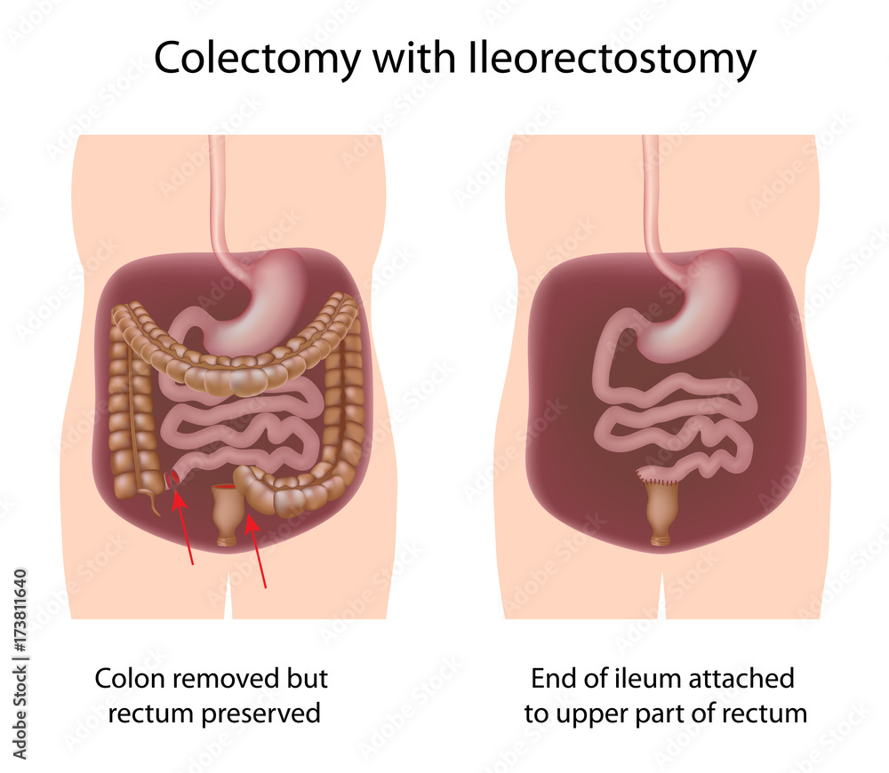 Colectomy with Ileorectostomy Stock Illustration | Adobe Stock