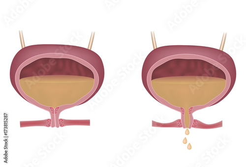 Stress urinary incontinence in women, unlabeled