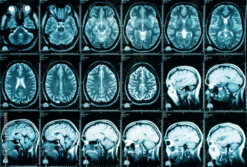 X-ray image of the brain computed tomography