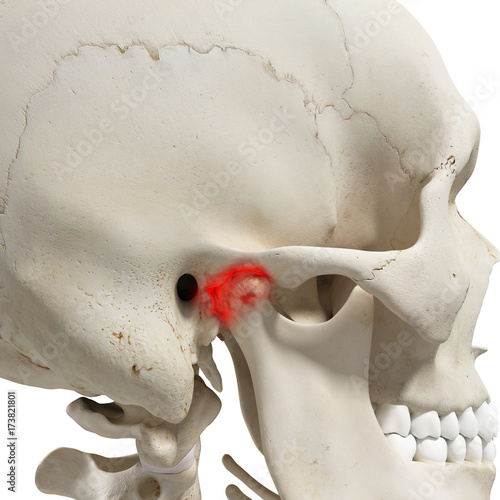 3d rendered medically accurate illustration of an arthritic mandible joint